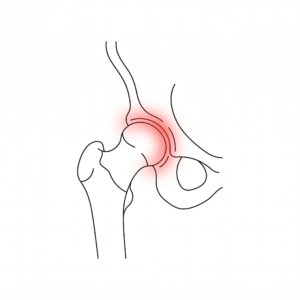 impacto femoroacetabular